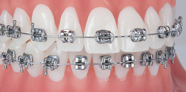 dental braces